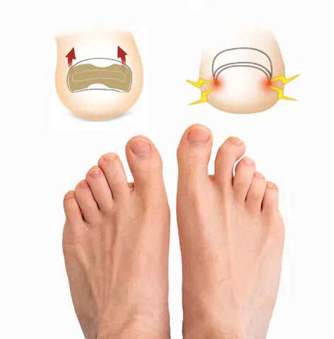 Parches Correctores para Uñas Encarnadas (30 unidades c/caja)