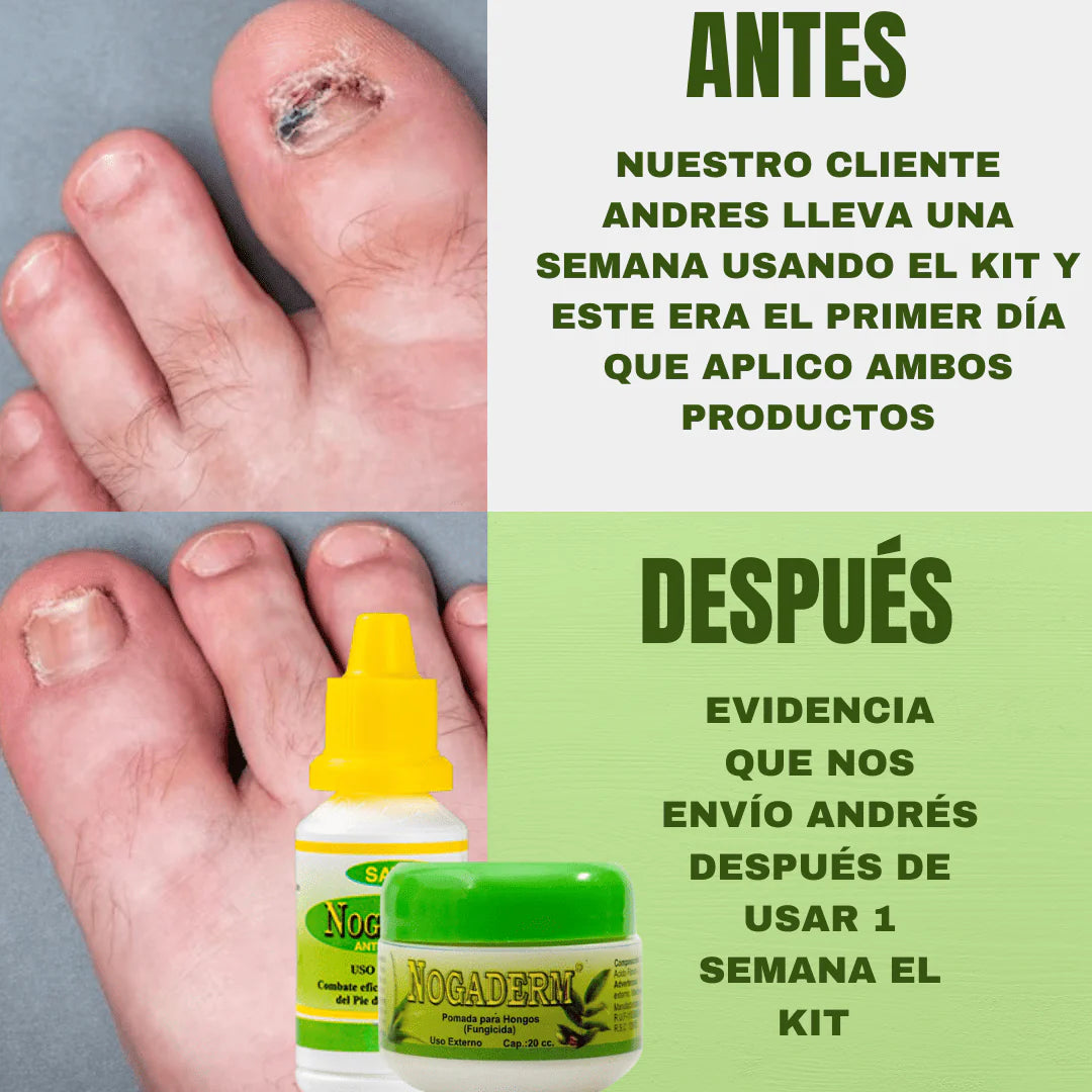 Gotas Antihongo – Fórmula Natural para la Regeneración de Uñas y Piel